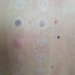 patch test